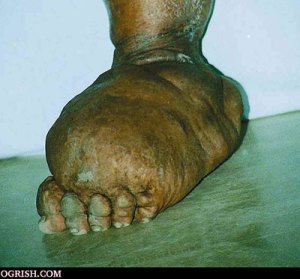 A foot infected with elephantiasis A foot infected with elephantiasis